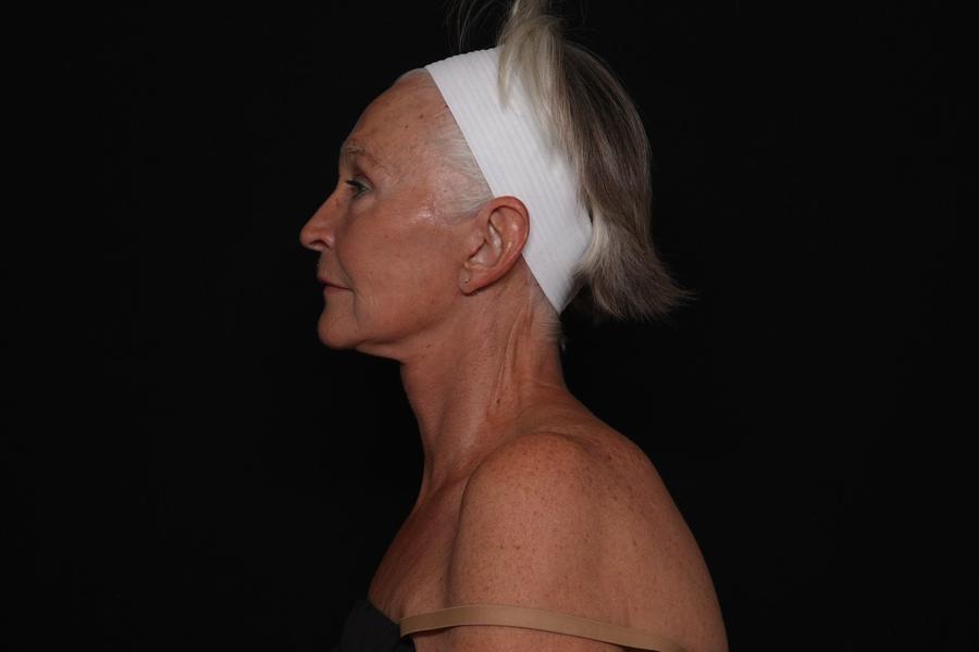 Facelift (neck lift included), view 5, after