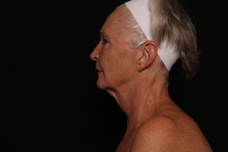 Facelift (neck lift included), view 5, before