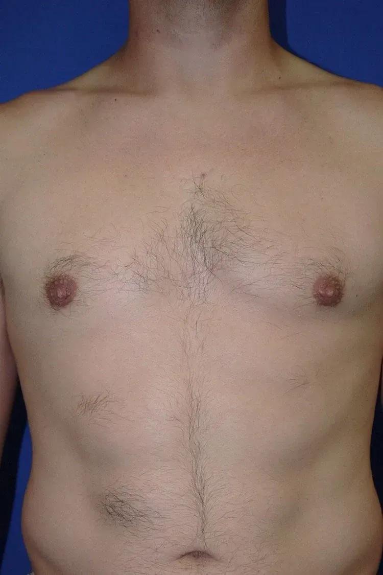 One-Stitch Gynecomastia after