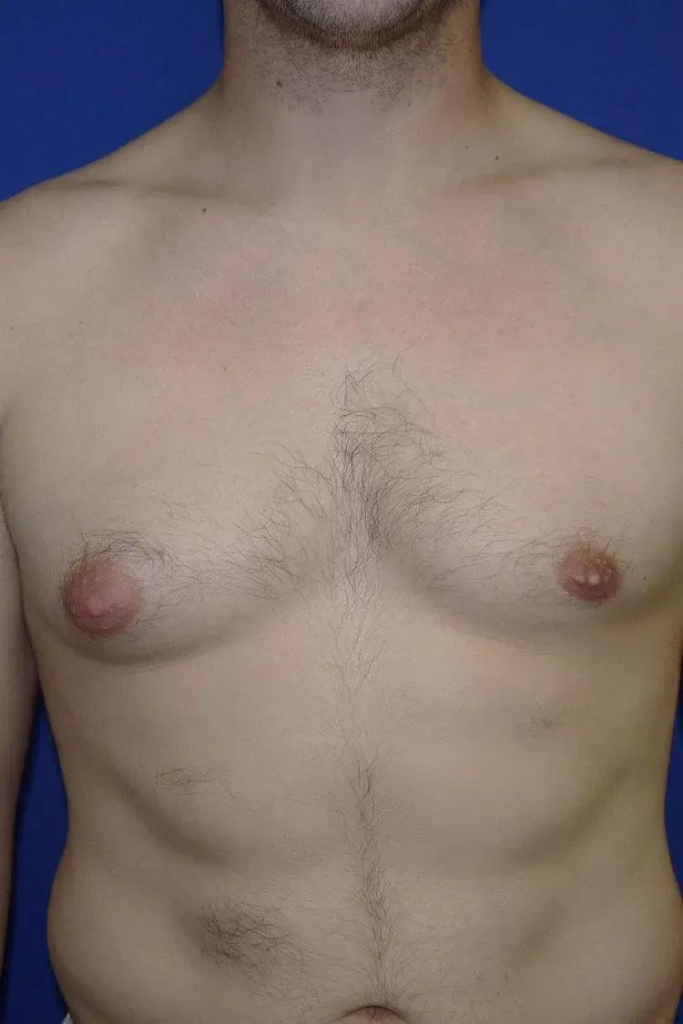 One-Stitch Gynecomastia before