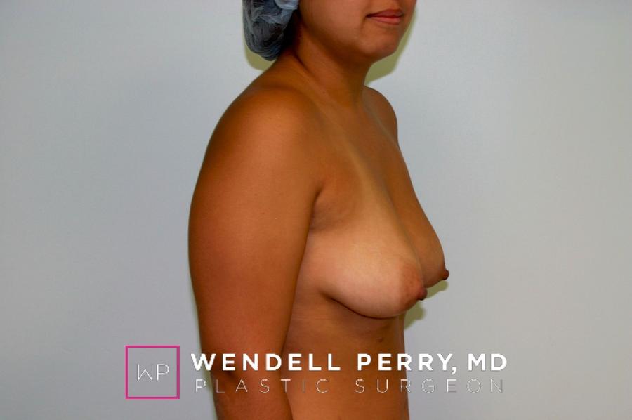 Breast Augmentation with Implants, view 3, before