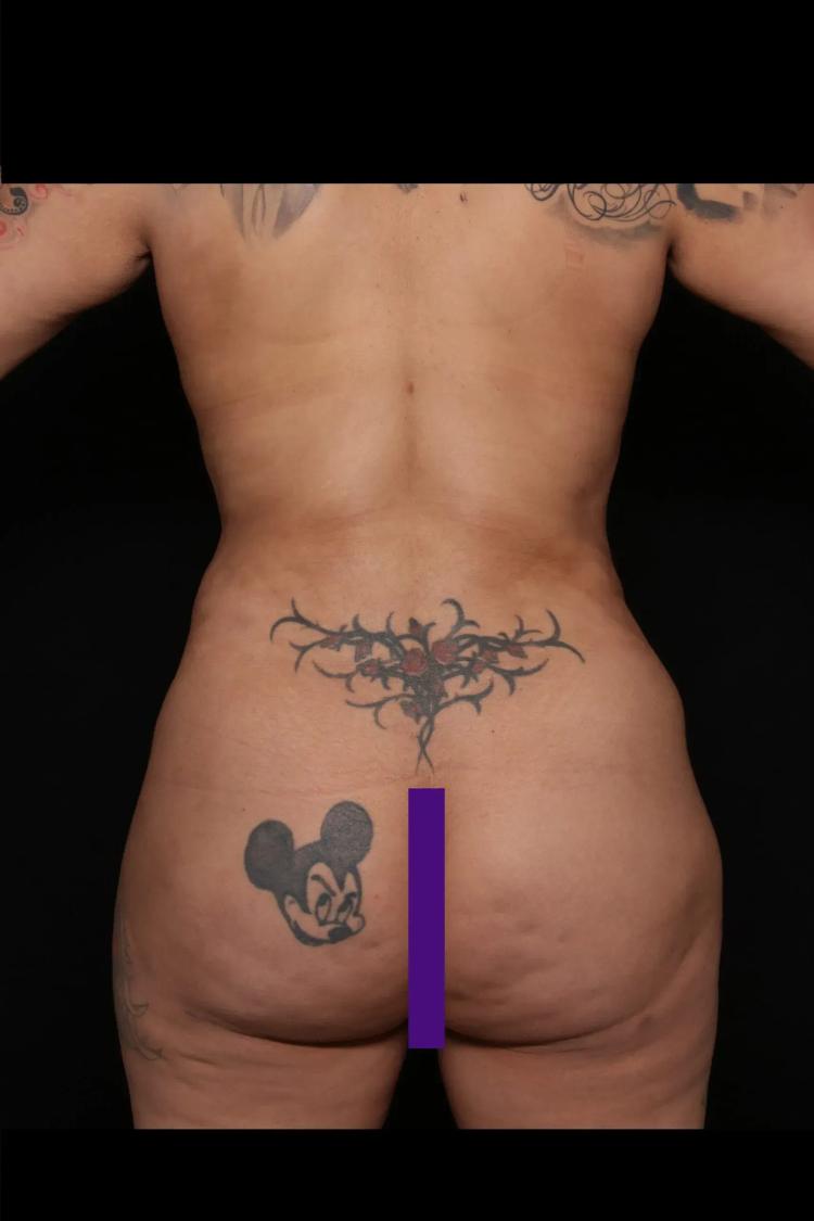 Front Liposuction (5L) (Same As Lipo360), view 3, after