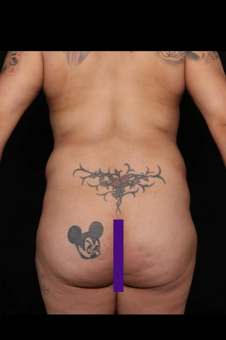Front Liposuction (5L) (Same As Lipo360), view 3, before