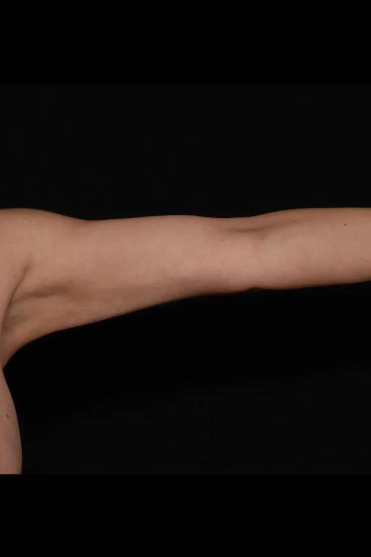 Arm Lift after