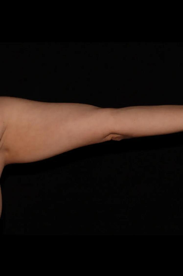 Arm Lift before
