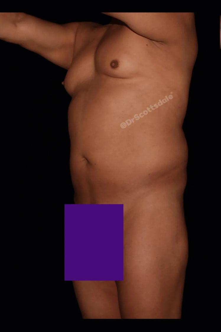 Vaser Lipo 360 (5L Max) before