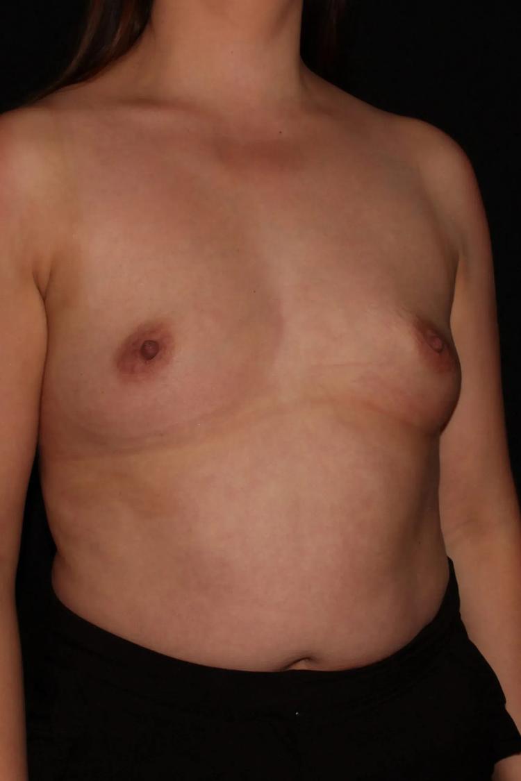 Breast Augmentation with Implants before