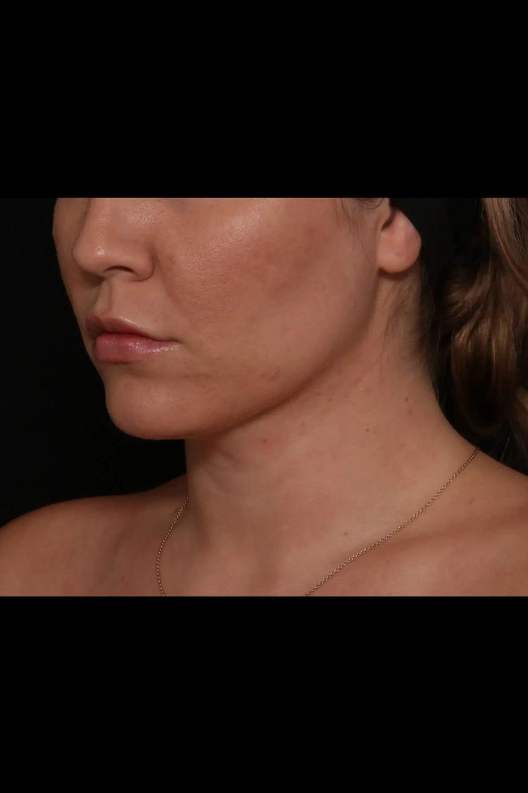 Neck Liposuction w/ Magic Tight after