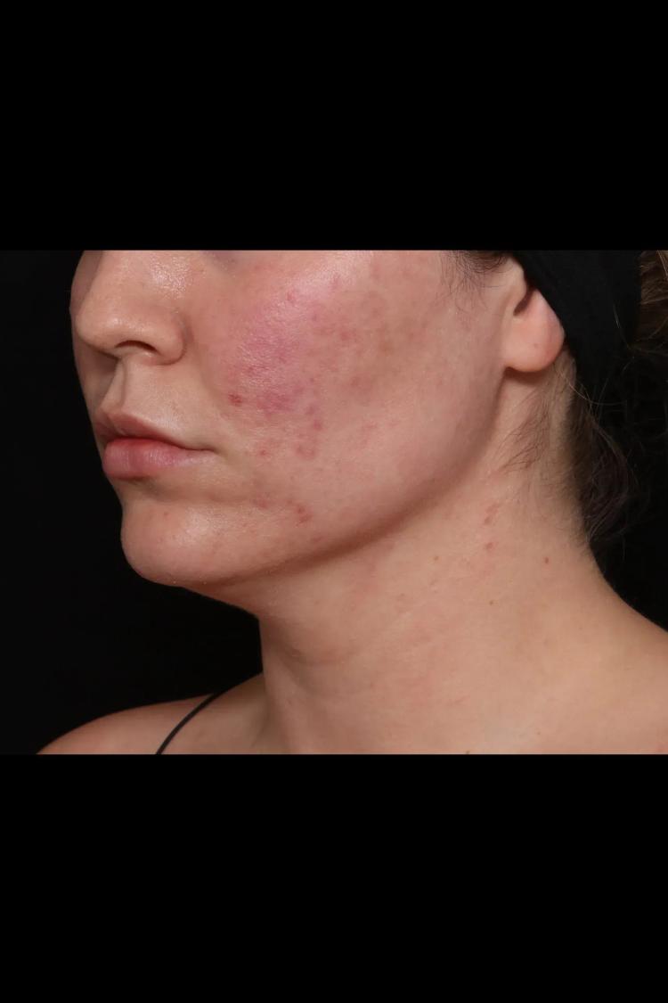 Neck Liposuction w/ Magic Tight before