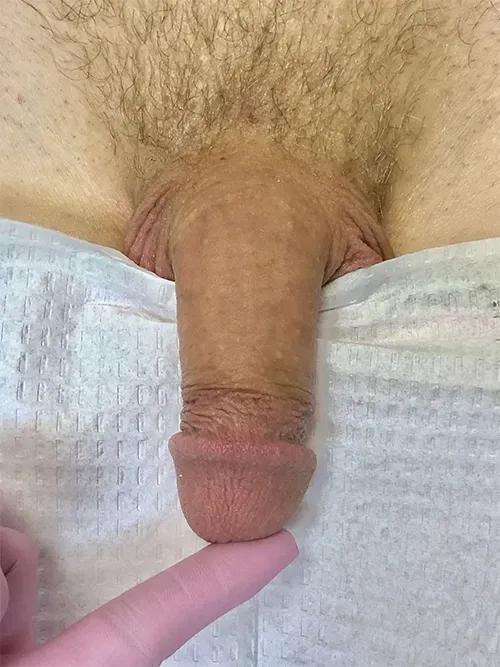 Penis Filler before