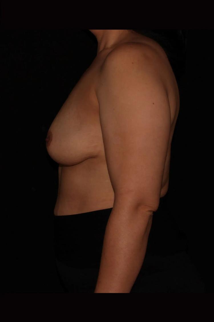 Breast Augmentation with Implants, view 3, before