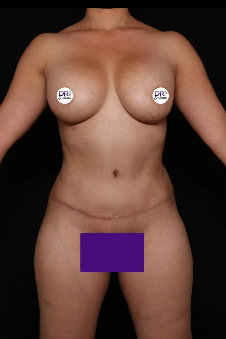 Tummy Tuck after