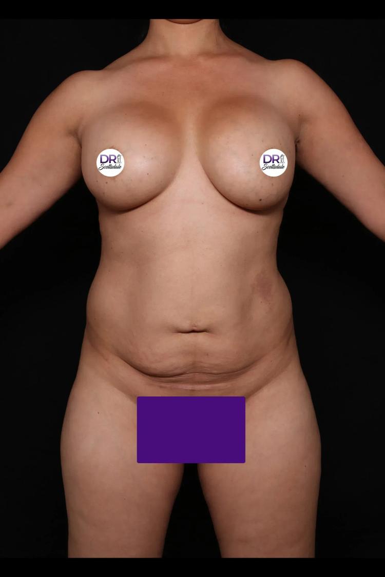 Tummy Tuck before