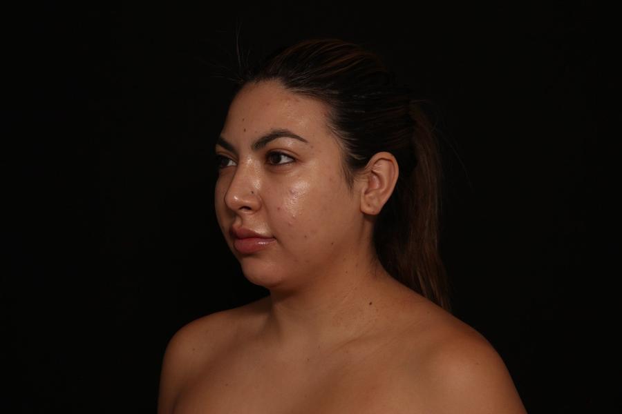 Neck Liposuction w/ Magic Tight, view 3, before