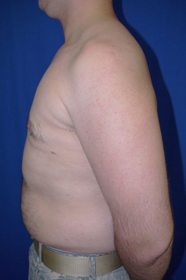 One-Stitch Gynecomastia, view 2, after