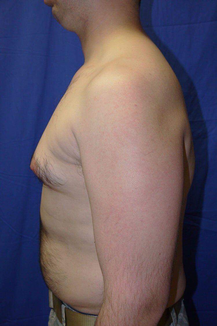 One-Stitch Gynecomastia, view 2, before