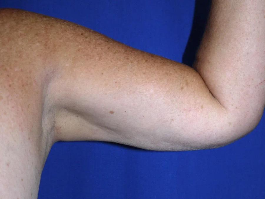 Arm Lift, view 2, after