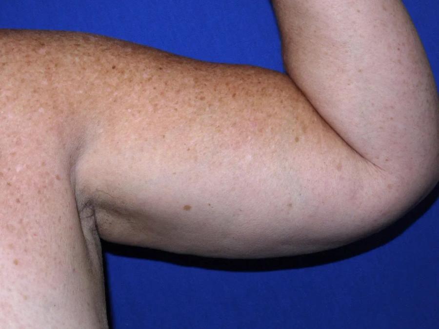 Arm Lift, view 2, before