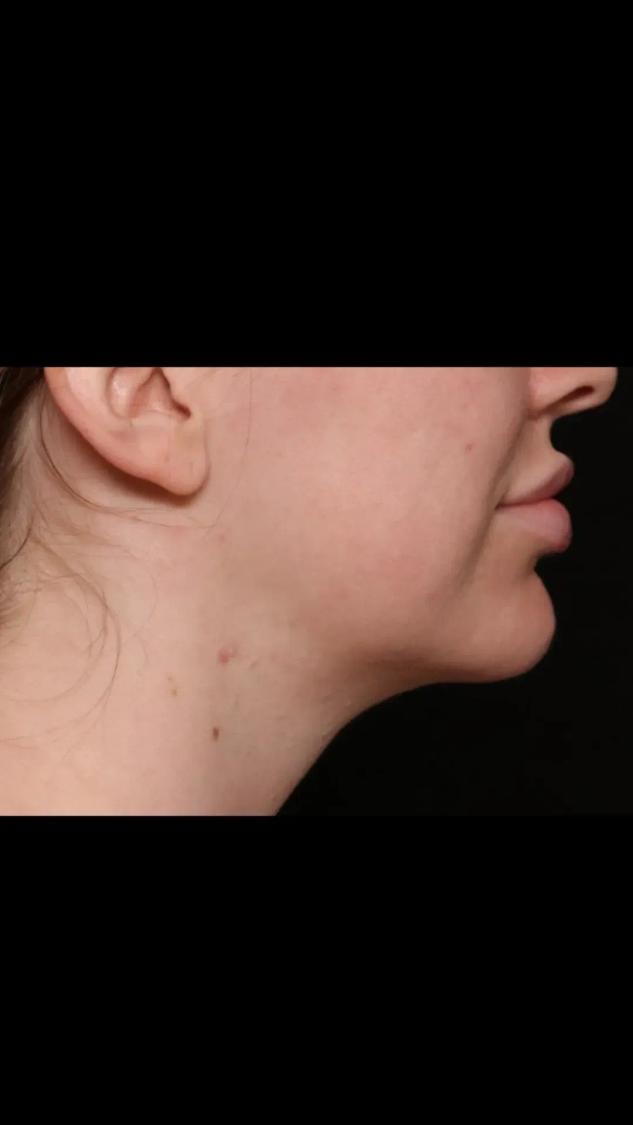 Neck Liposuction w/ Magic Tight, view 2, after