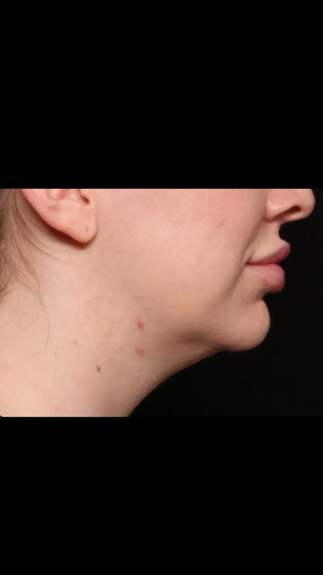 Neck Liposuction w/ Magic Tight, view 2, before