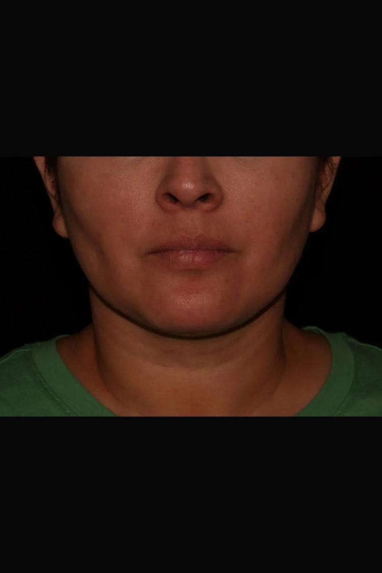 Buccal Fat Pad Removal after