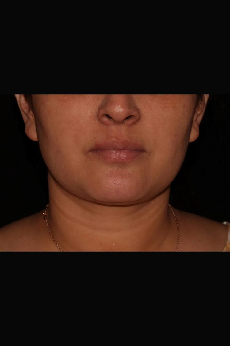 Buccal Fat Pad Removal before