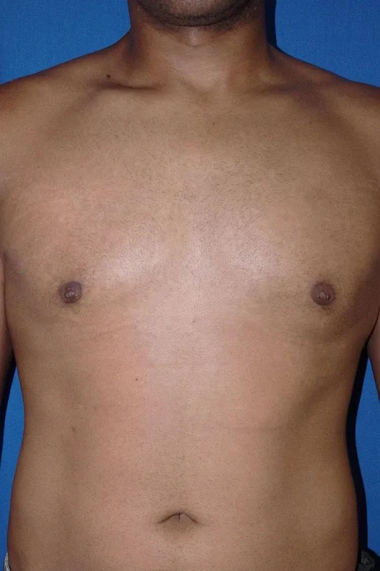 One-Stitch Gynecomastia after