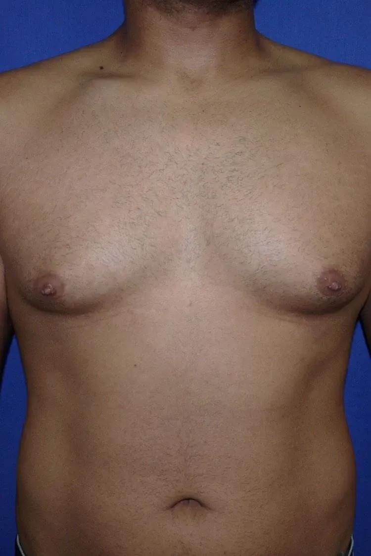 One-Stitch Gynecomastia before