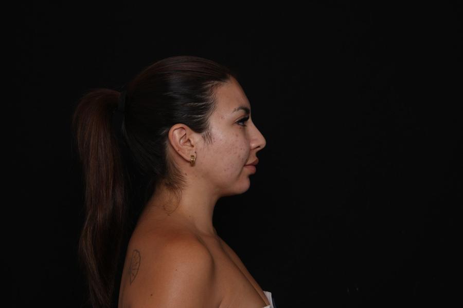 Neck Liposuction w/ Magic Tight, view 4, after