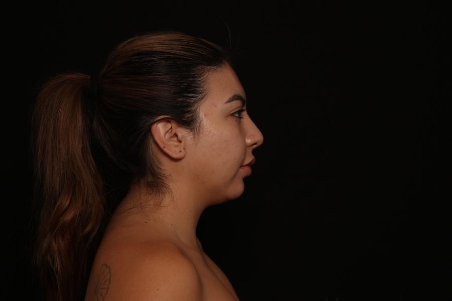 Neck Liposuction w/ Magic Tight, view 4, before