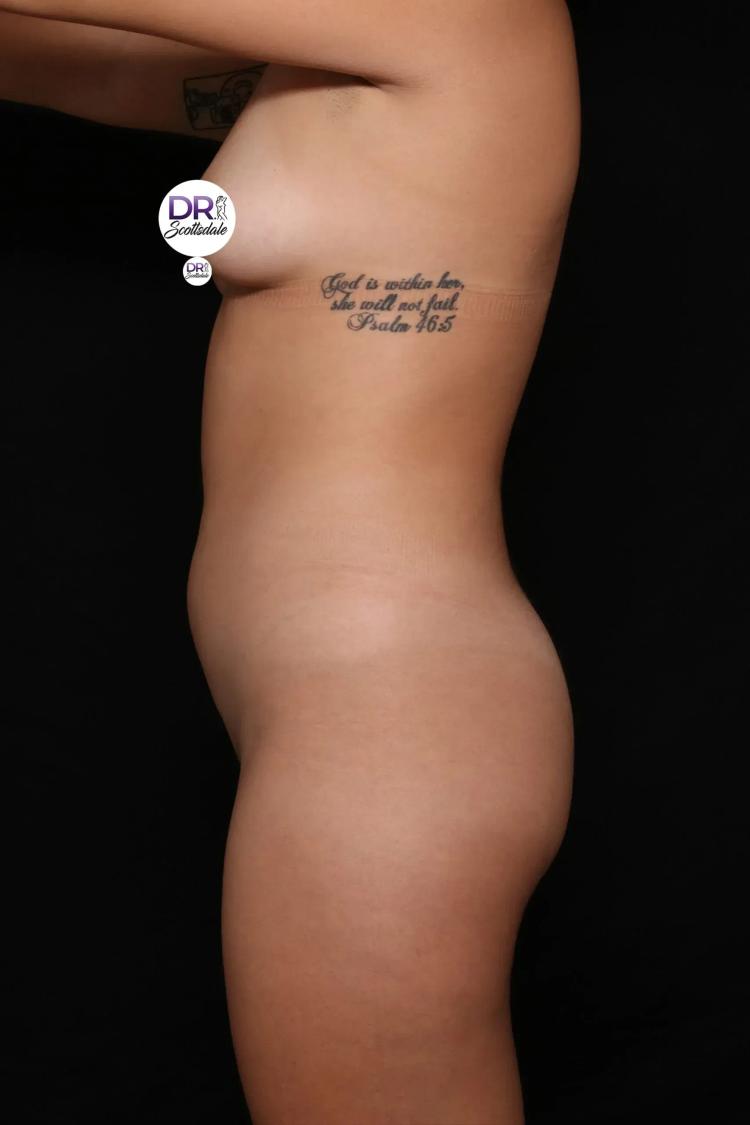 Vaser Lipo 360 (5L Max), view 3, before