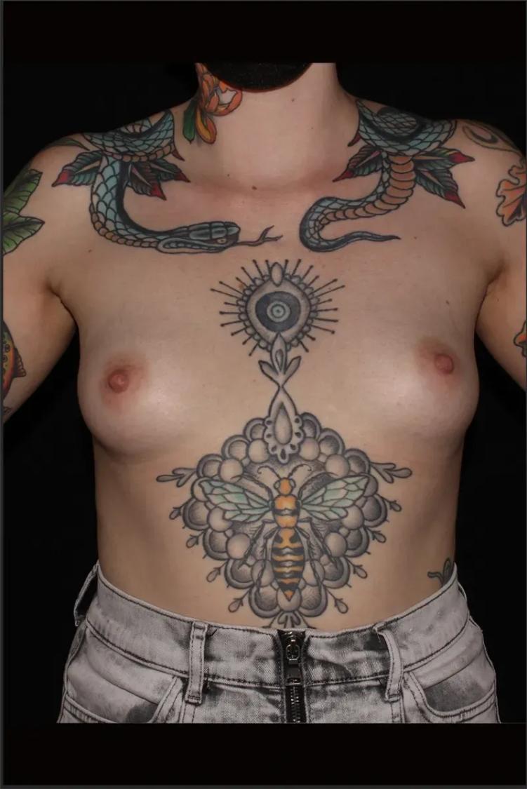 Breast Augmentation with Implants before