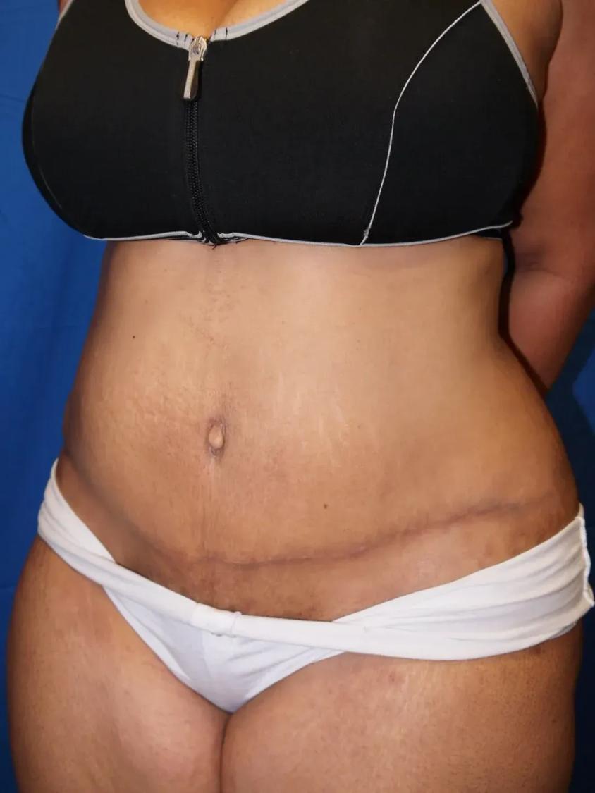 Tummy Tuck after