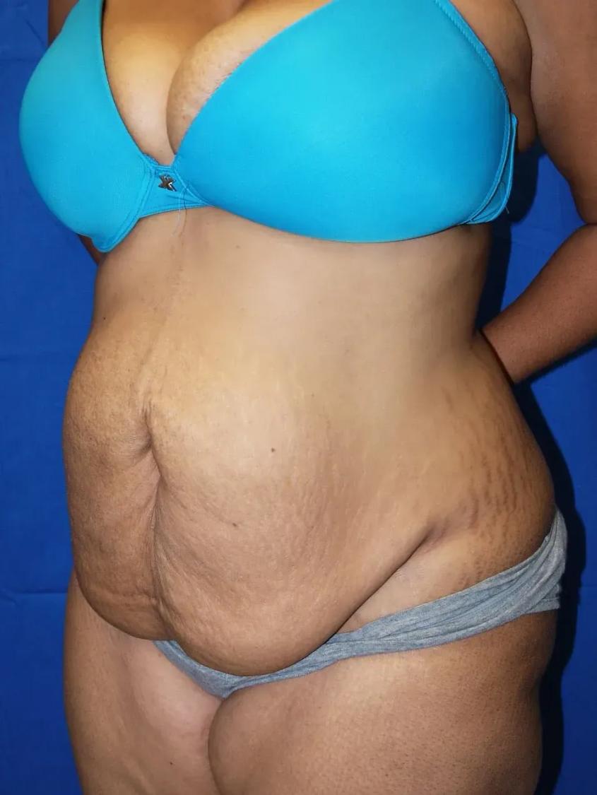 Tummy Tuck before