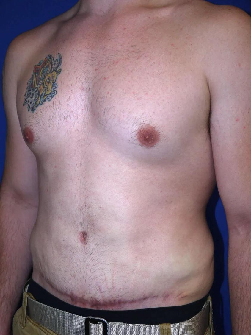 Tummy Tuck, view 2, after