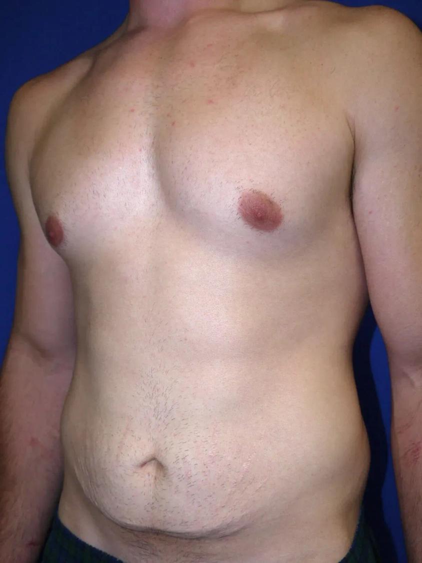 Tummy Tuck, view 2, before