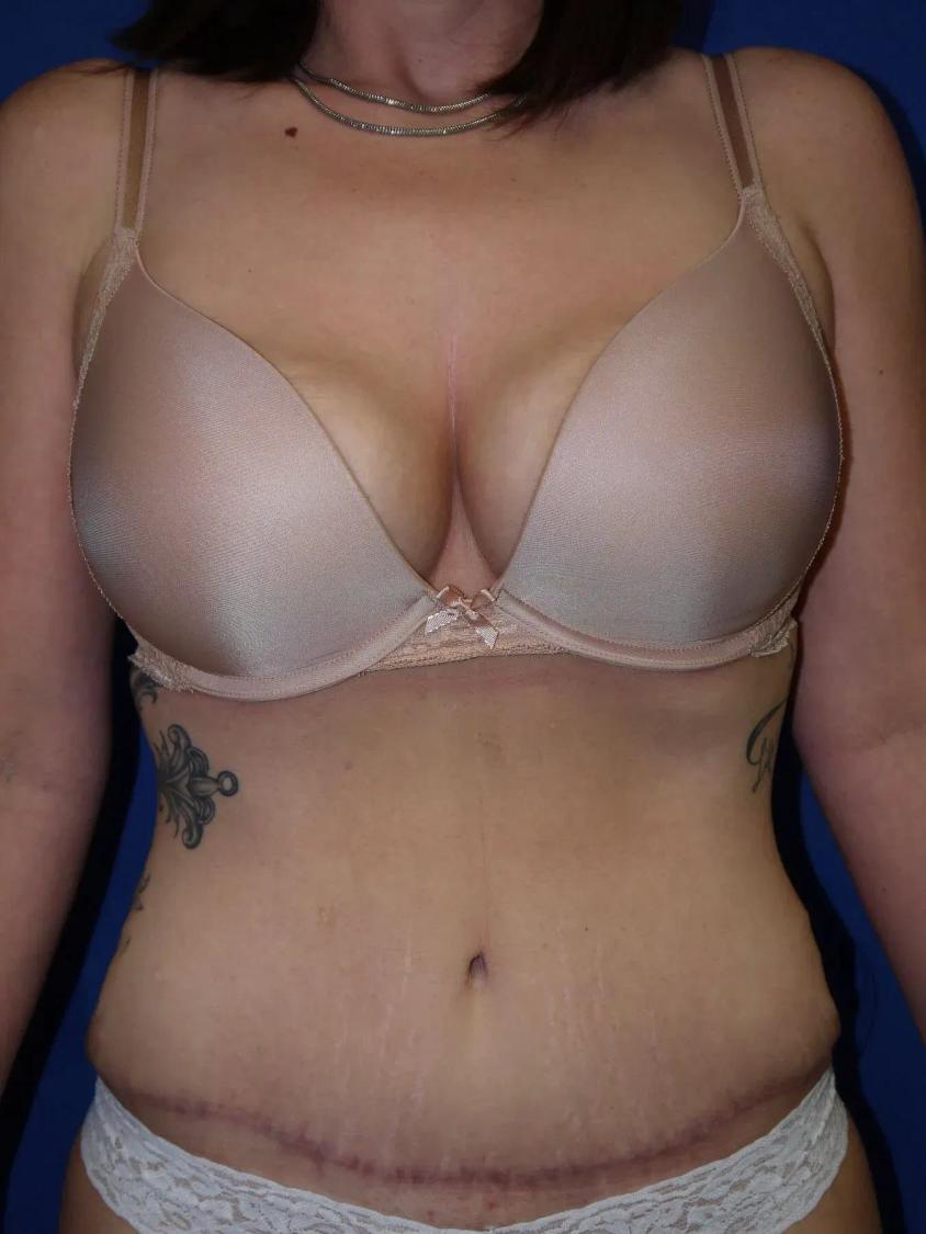 Tummy Tuck after