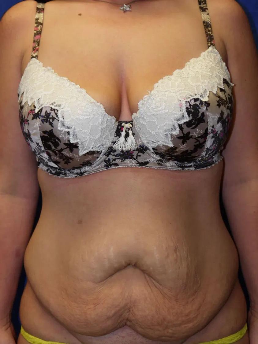 Tummy Tuck before