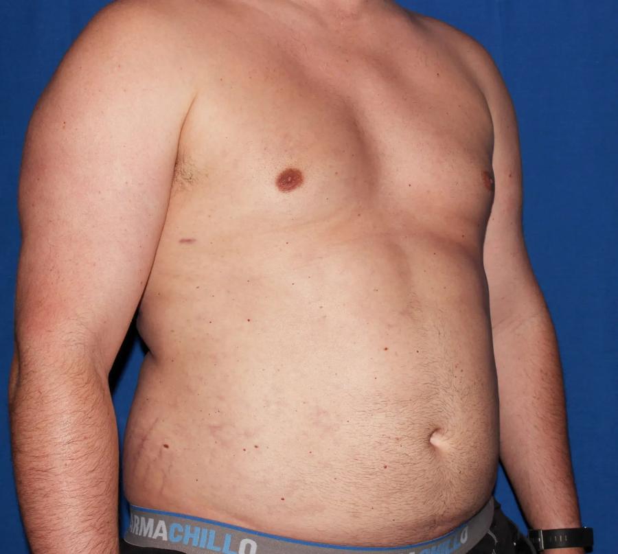 One-Stitch Gynecomastia after