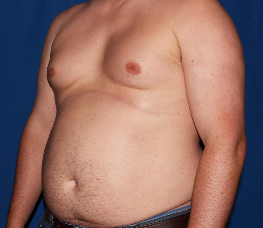 One-Stitch Gynecomastia before