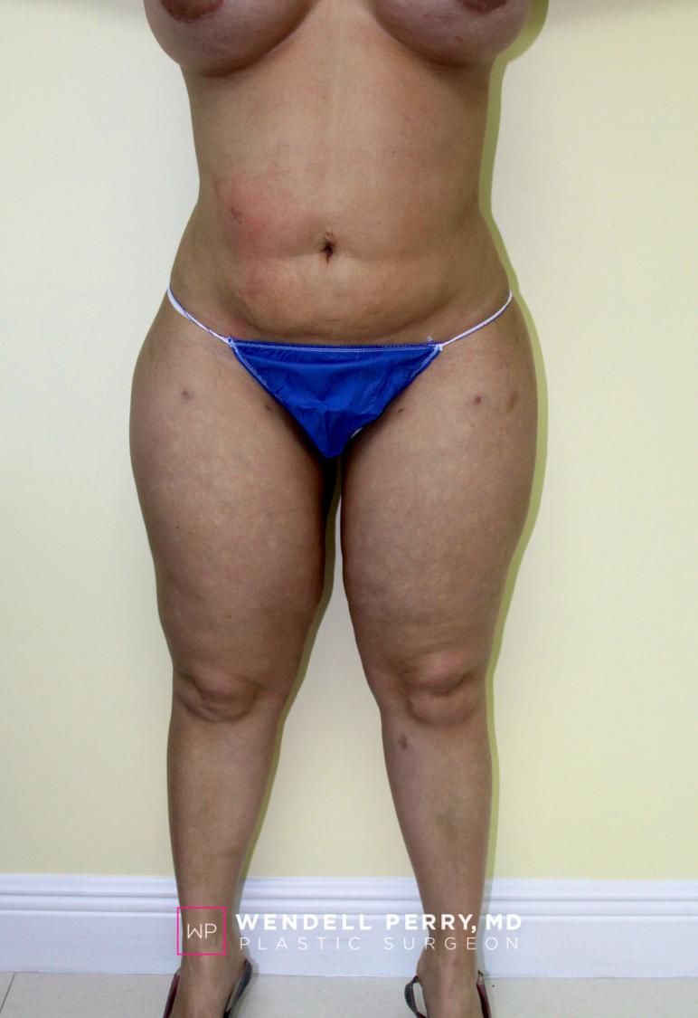Liposuction after