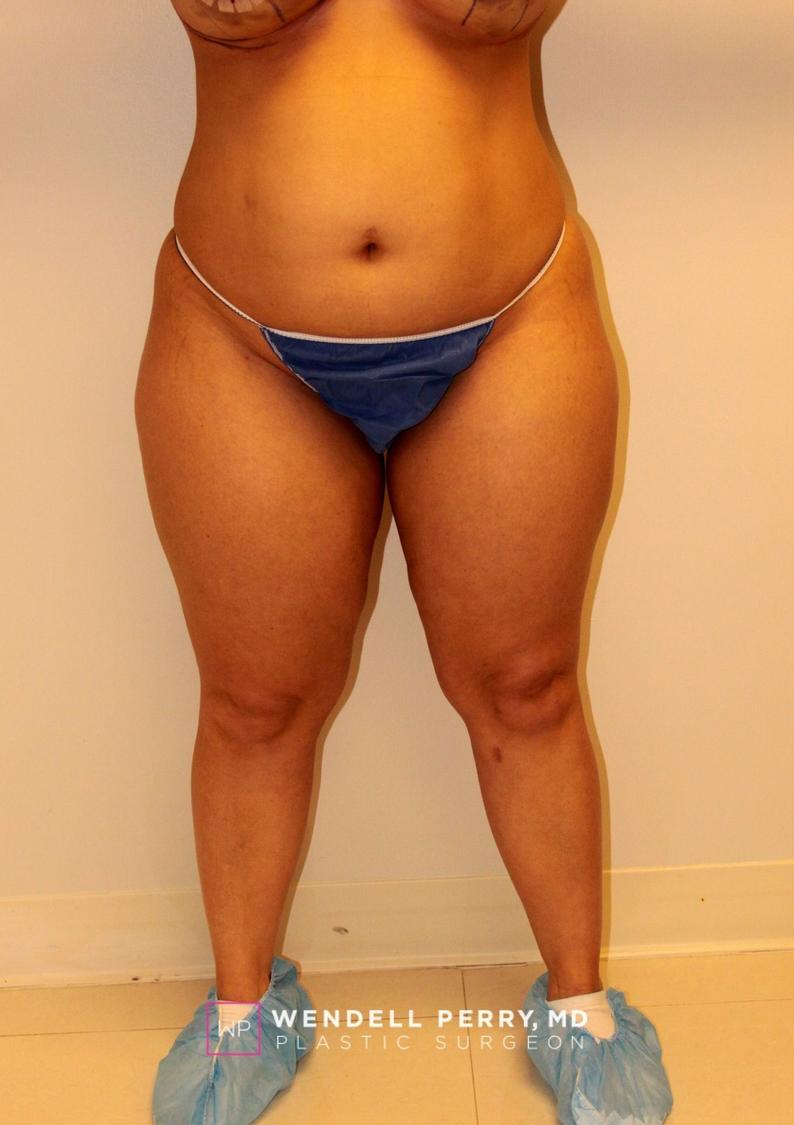 Liposuction before