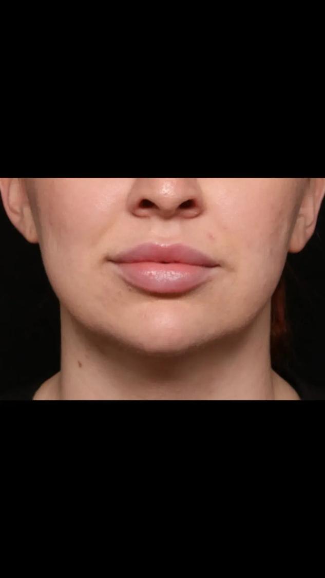 Neck Liposuction w/ Magic Tight after