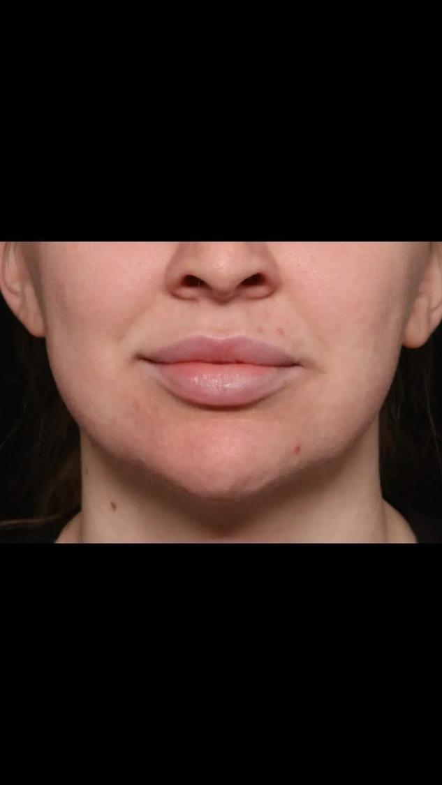 Neck Liposuction w/ Magic Tight before