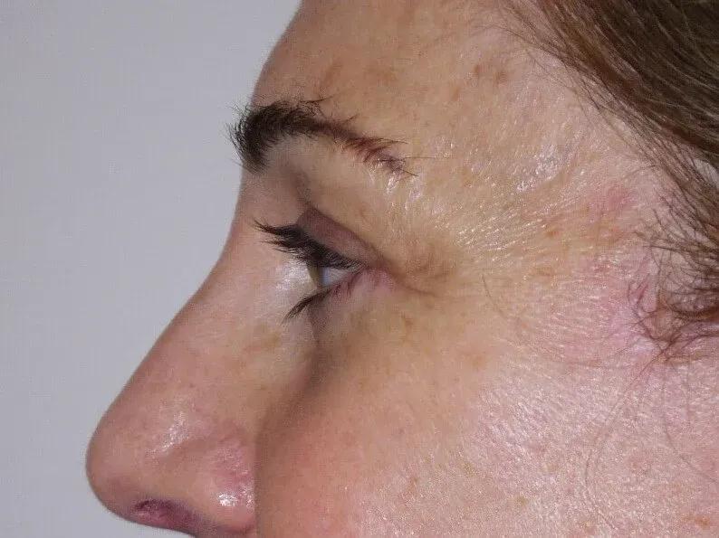 Eyelid Surgery, view 2, after
