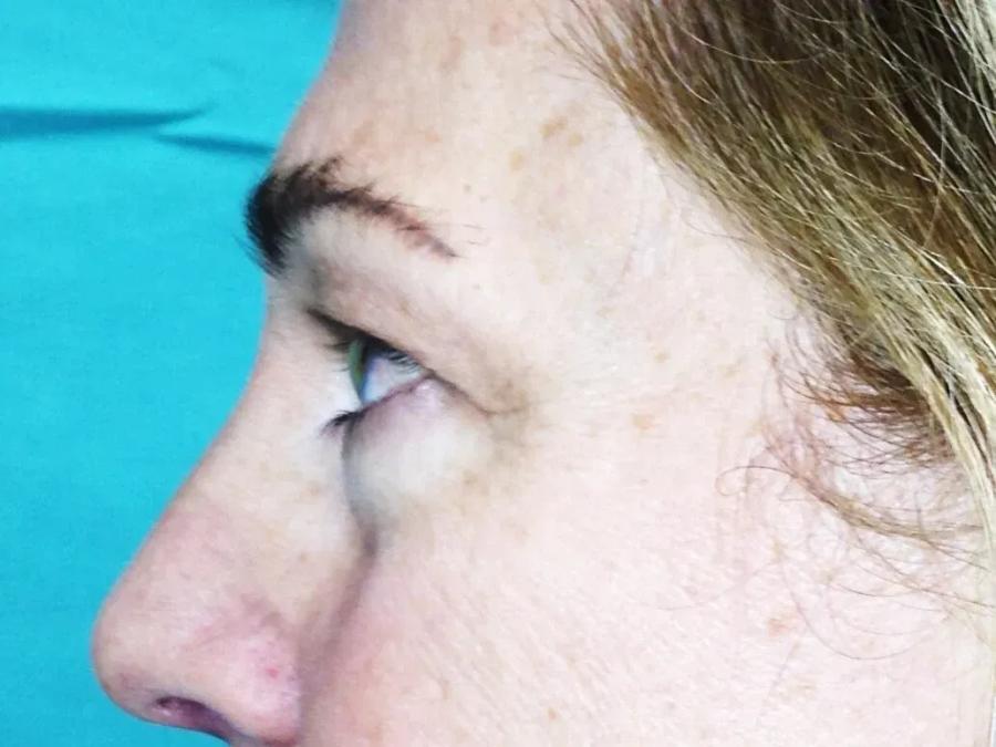 Eyelid Surgery, view 2, before