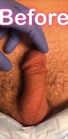 Penis Filler before