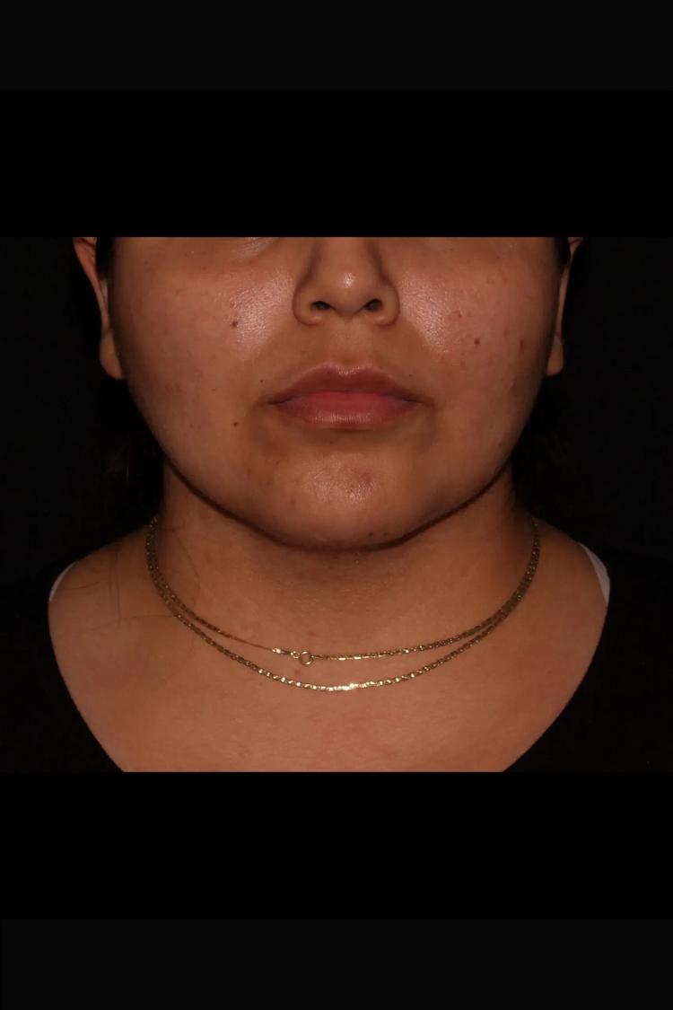 Buccal Fat Pad Removal after