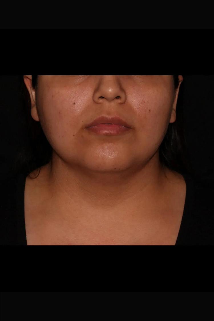 Buccal Fat Pad Removal before