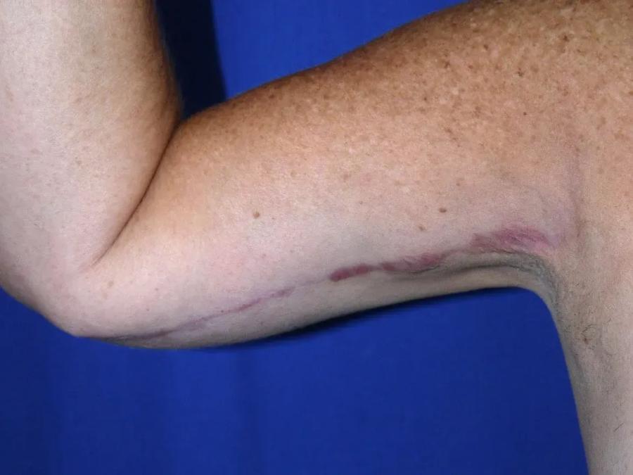 Arm Lift after